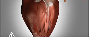 Новый метод пластики митрального клапана на работающем сердце